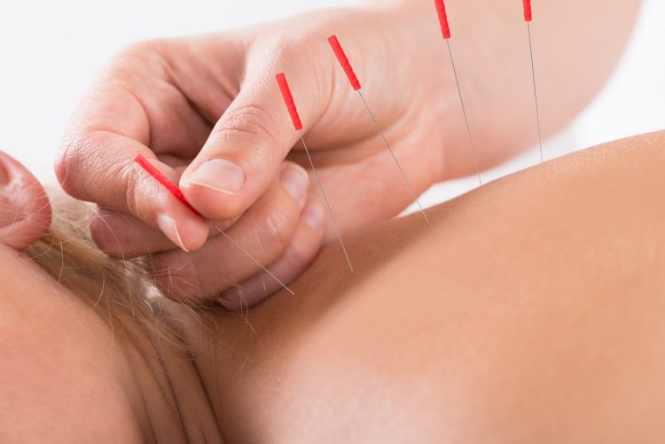 Woman Getting Acupuncture
