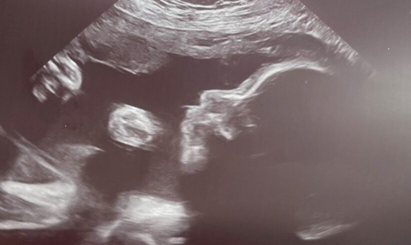 Ultrasound image showing a side profile of a developing fetus, with the head, nose, and body clearly visible. The black and white scan highlights the baby inside the womb.
