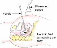 Medical illustration showing a needle inserted into a pregnant abdomen for amniocentesis, with an ultrasound device guiding the needle to collect amniotic fluid surrounding the baby. Labels identify key parts.