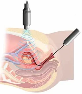 A medical illustration showing a fetus in the womb, with an ultrasound probe above the abdomen and a needle inserted into the uterus, demonstrating a prenatal diagnostic procedure.