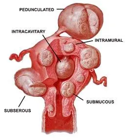 Graphic representation of locations and different types of uterine fibroids