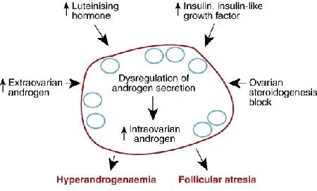 Diagram showing factors leading to dysregulation of androgen secretion in an ovary, resulting in hyperandrogenaemia and follicular atresia. Factors include luteinising hormone, insulin, ovarian block, and extraovarian/intraovarian androgens.