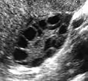 Black and white ultrasound image showing multiple dark, round cysts clustered within ovarian tissue, suggestive of polycystic ovary syndrome (PCOS).