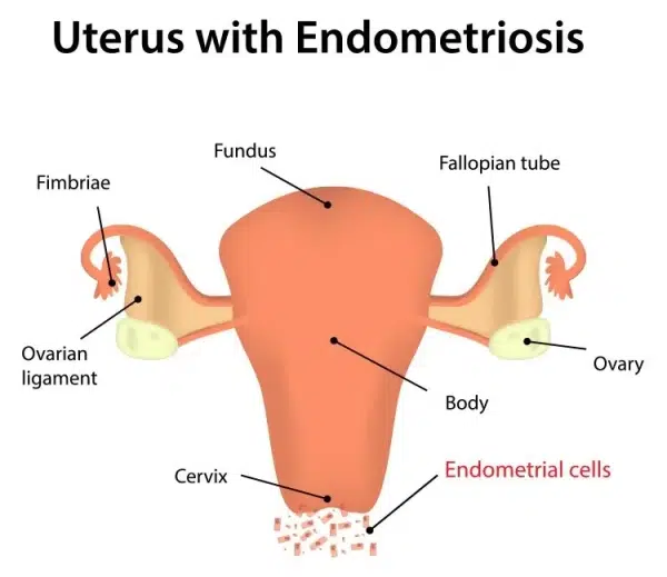 Diagram of a uterus with labeled parts: fimbriae, ovarian ligament, ovary, fundus, fallopian tube, body, and cervix. Endometrial cells are shown outside the uterus, indicating endometriosis.