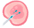 image of In Vitro Fertilization (IVF)