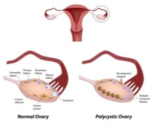 Diagram comparing a normal ovary and a polycystic ovary. The normal ovary shows follicle development and ovulation, while the polycystic ovary shows multiple immature follicles with halted development.