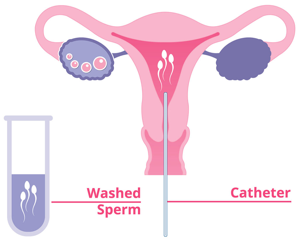 Diagram showing intrauterine insemination: washed sperm in a test tube being inserted into a uterus using a catheter, with labeled ovaries, fallopian tubes, and sperm movement toward the uterine cavity.
