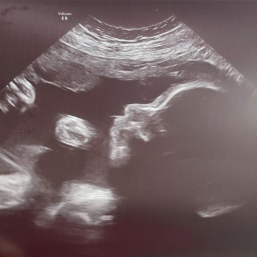 Ultrasound image showing a side profile of a developing fetus, with the head, nose, and body clearly visible. The black and white scan highlights the baby inside the womb.