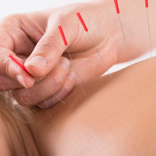 A close-up of a persons back receiving acupuncture, with several thin needles inserted into the skin and a practitioners hand gently placing one needle.