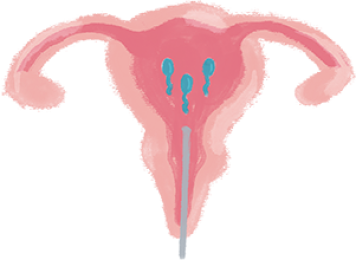 Illustration of a human uterus in pink with three blue sperm cells inside, swimming toward the egg, representing fertilization or conception.
