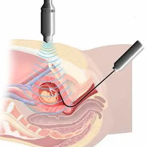 A medical illustration showing a fetus in the womb, with an ultrasound probe above the abdomen and a needle inserted into the uterus, demonstrating a prenatal diagnostic procedure.