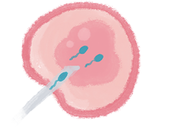 Illustration of an egg cell with two sperm cells approaching it and a medical instrument injecting material into the egg, representing in vitro fertilization (IVF).